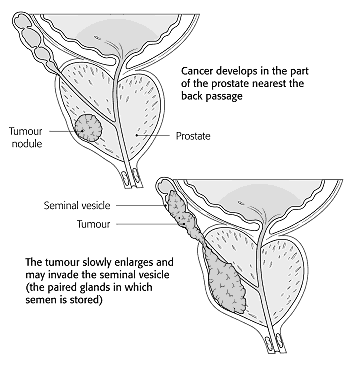 Figure 3: Cancer development