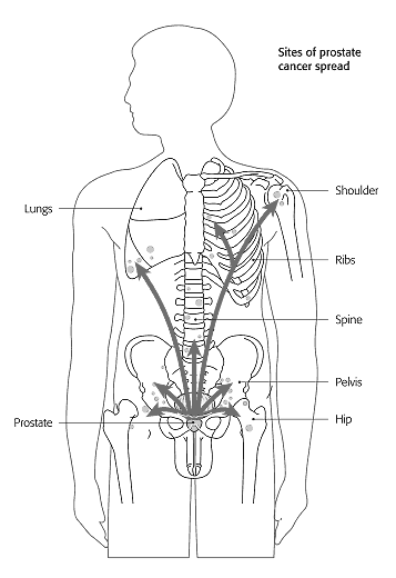 Figure 4: Spread of prostate cancer