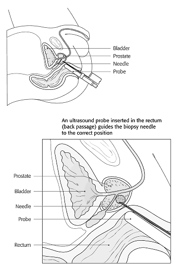Figure 6: Prostate biopsy