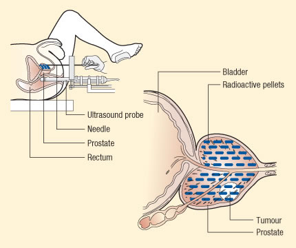 Brachytherapy