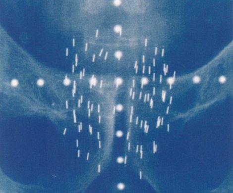 Brachytherapy pellets